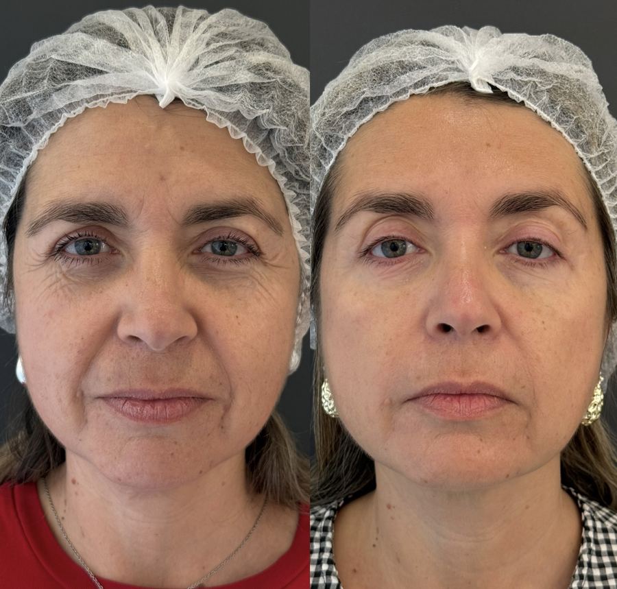 Caso real del Método de Bioestimulación Celular — paciente 5