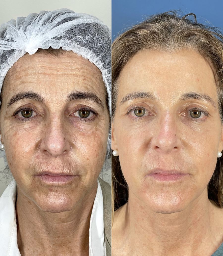 Caso real del Método de Bioestimulación Celular — paciente 8